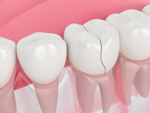 Do you have broken dental Implant?