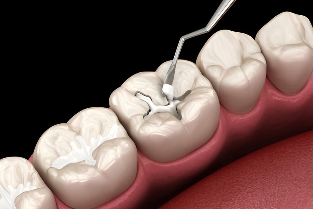 Are Composite Fillings Safe? A Closer Look at the Materials Used