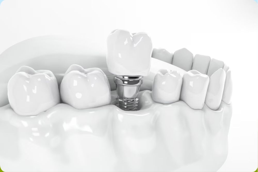 dental Implants in Ipswich